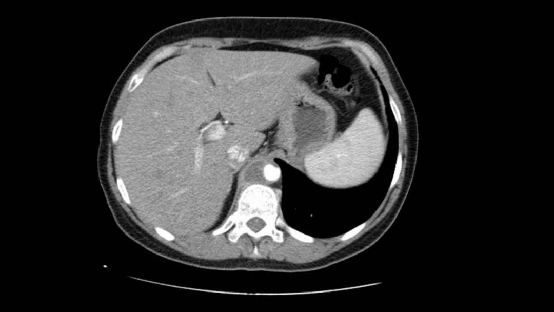 Viernes Quirúrgico: Aneurisma de arteria hepática derecha