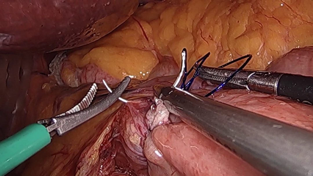 Bypass gástrico laparoscópico con comprobación de irrigación con verde de indocianina