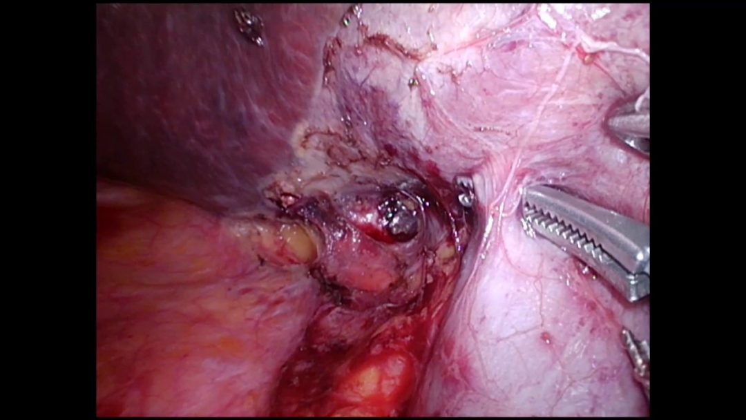 1er curso de cirugía mínimamente invasiva hepatobiliopancreática