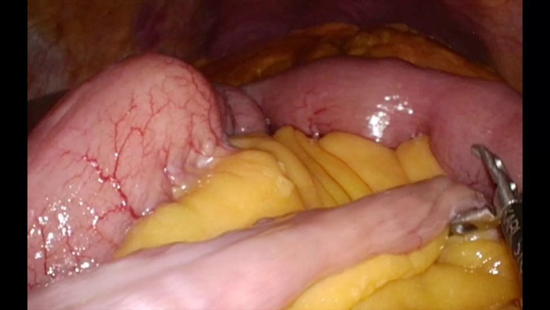 Bypass gástrico por puerto único con anastomosis manual con torre 3D