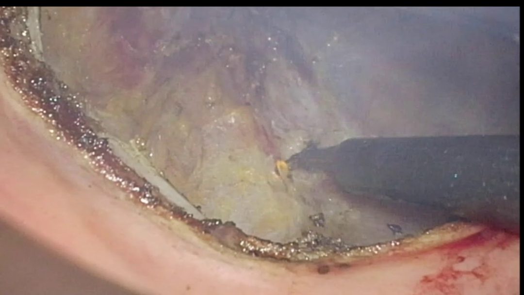 Exéresis total de mesorrecto transanal con inmunofluorescencia